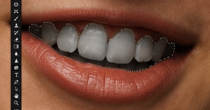 Dents désaturées