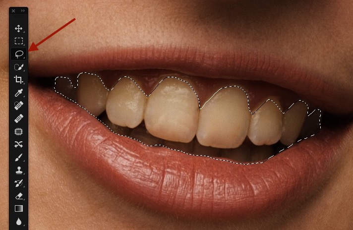Lasso dents